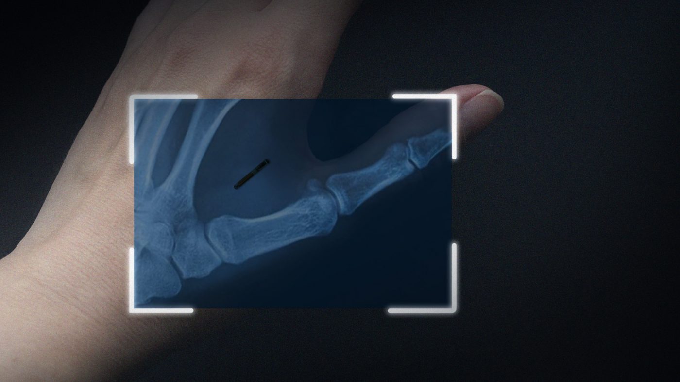 Implanted Microchip in Hand